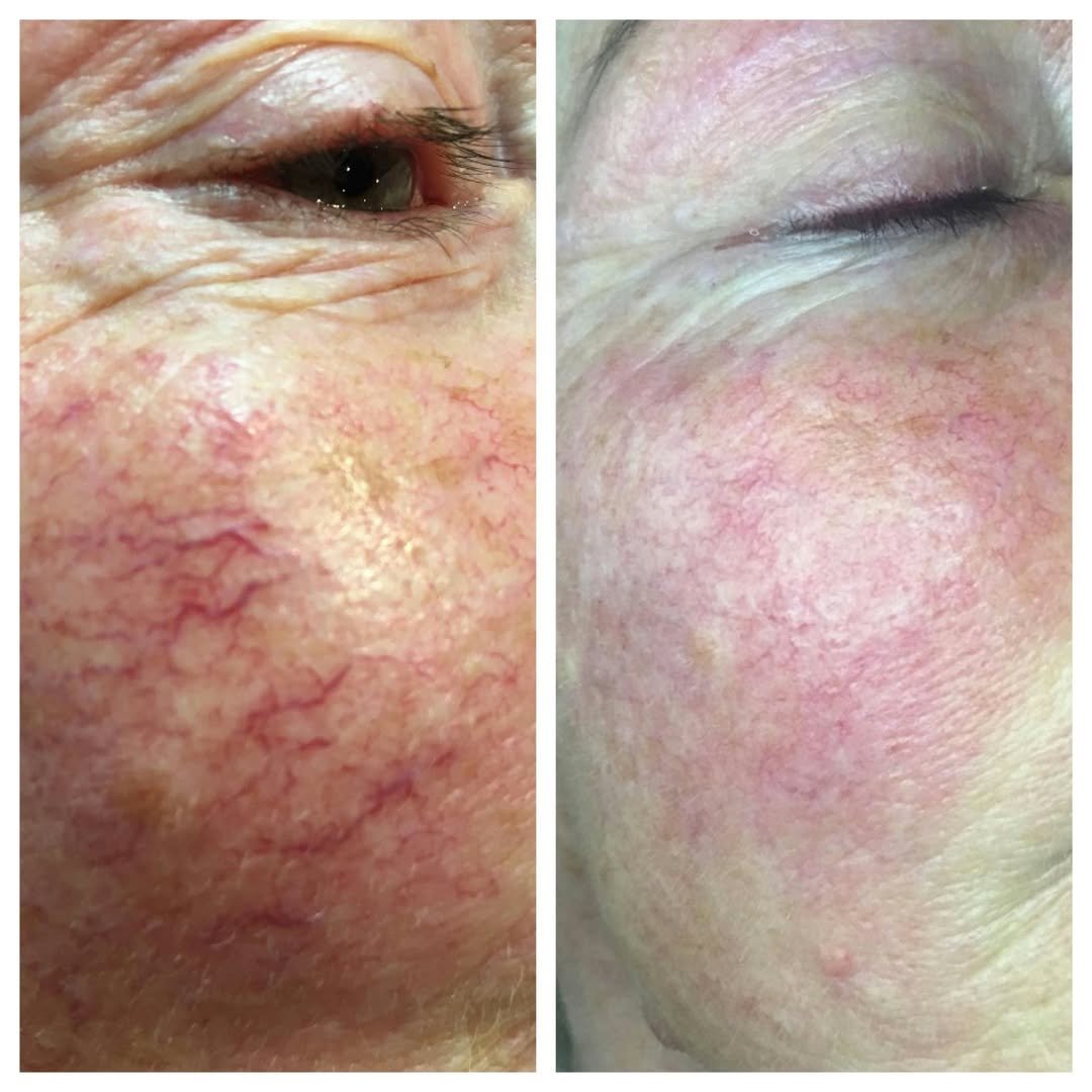 Red Vein Treatment